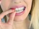 Bleaching - Zähne aufhellen