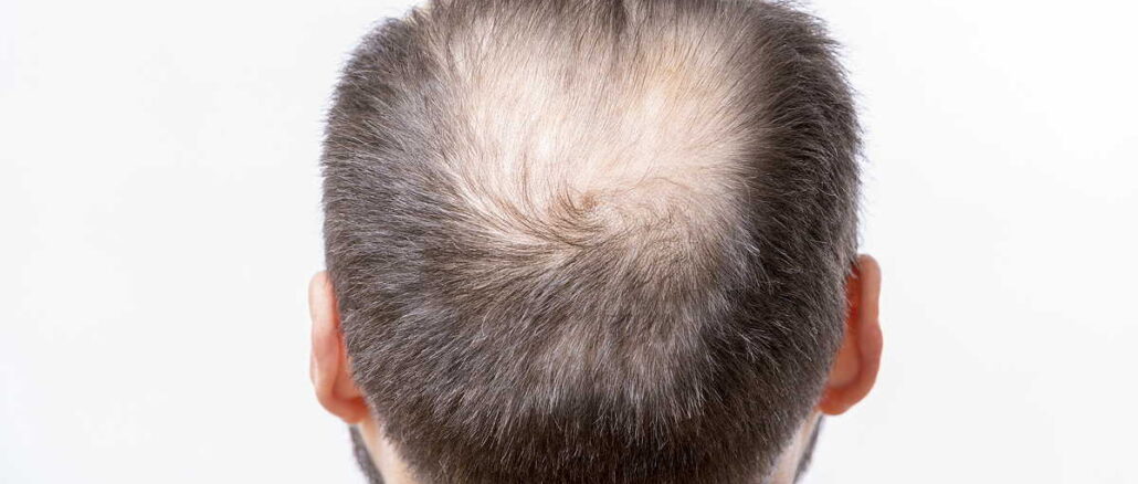 Haarsysteme für Männer mit Haarausfall: Die moderne Lösung für volles Haar