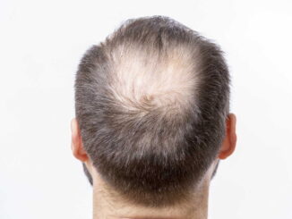Haarsysteme für Männer mit Haarausfall: Die moderne Lösung für volles Haar