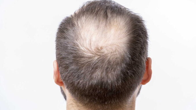 Haarsysteme für Männer mit Haarausfall: Die moderne Lösung für volles Haar