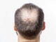 Haarsysteme für Männer mit Haarausfall: Die moderne Lösung für volles Haar