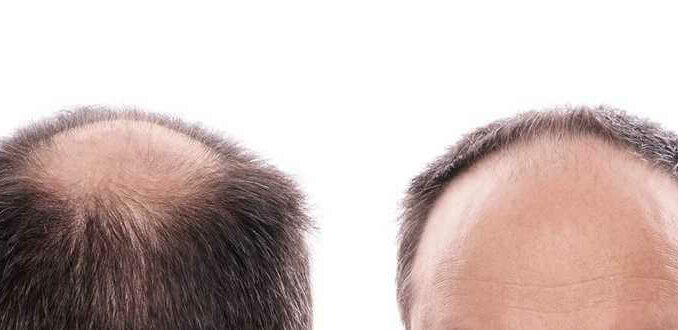 Haarausfall und was man dagegen tun kann