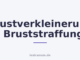 Brustverkleinerung / Bruststraffung
